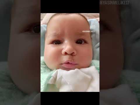 Yarık dudak tedavisi