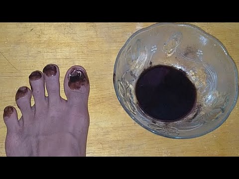 Dzięki temu zioło, paznokieć grzyb leczy w 5 godzin w domu