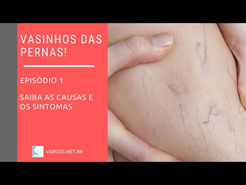 , title : 'Causas e sintomas dos vasinhos das pernas'