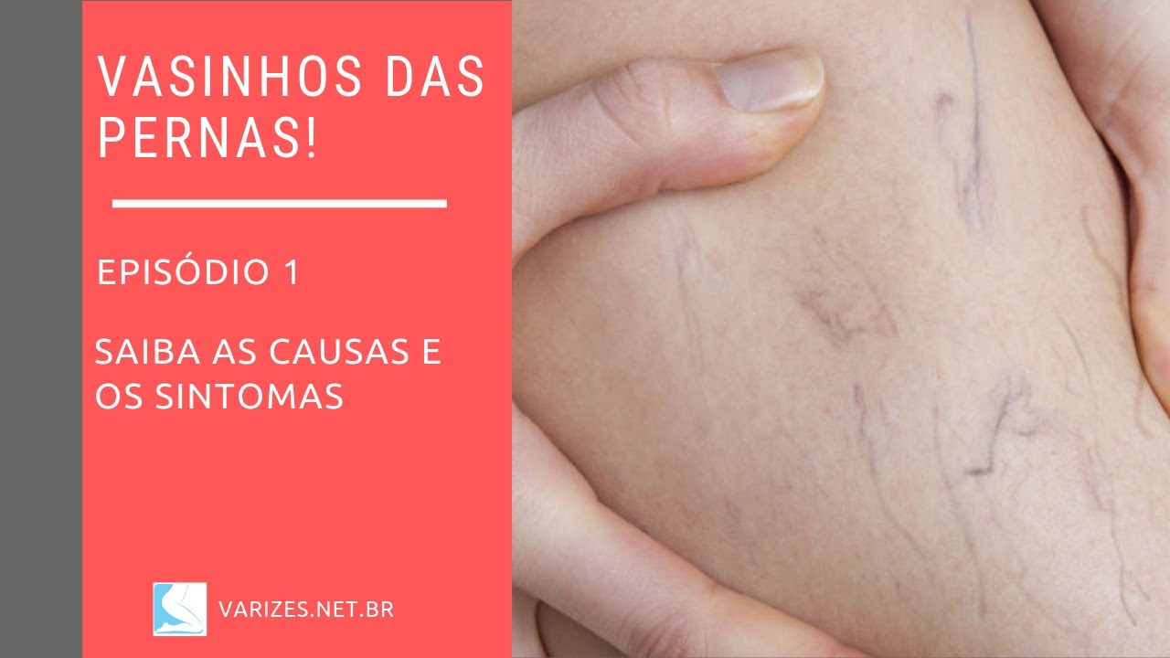 Causas e sintomas dos vasinhos das pernas
