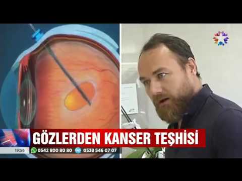 Op.Dr. Özer Kavalcıoğlu – Star TV – Gözler Hastalıkların Aynası