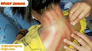 Download lagu Lama Ga kerokan langsung Merah #kerokan mp3 Download lagu Lama Ga kerokan langsung Merah #kerokan mp3