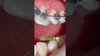 How Ligature Placed on the Bracket|Ligature Placed on Braces|Orthodontic Dentistry Treatments🦷