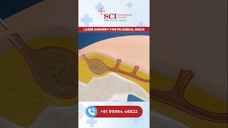 Pilonidal Sinus ka Laser Ilaj – Bina Kaat, Bina Dard, Bina Stitches #pilonodal #sinus #stitches