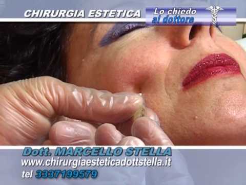 Basso e con sollevamento di faccia Chirurgia plastica sullo stringimento di persona di una fotografia prima di e poi