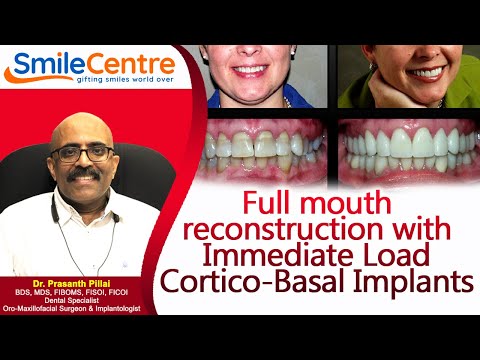 Full mouth reconstruction with Immediate Load Cortico-Basal Implants at Smile Centre India