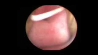 Βιντεο 01 στένωμα ουρήθρας μετά από τροχαίο