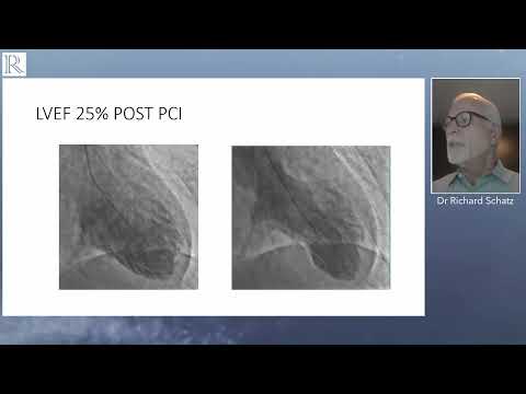 ZOLL TherOx - Radcliffe Webinar 2 Burkhoff Schatz - English