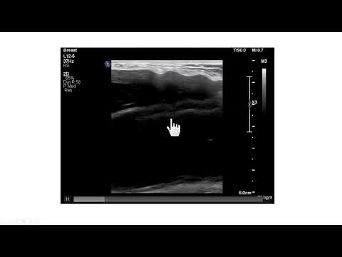 Artefato torácico simulando rutura intracapsular em modelos recentes de prótese mamária.