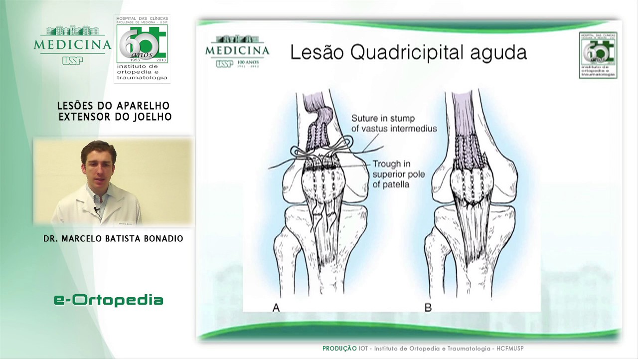 Lesões do Aparelho Extensor do Joelho - Dr. Marcelo Bonadio