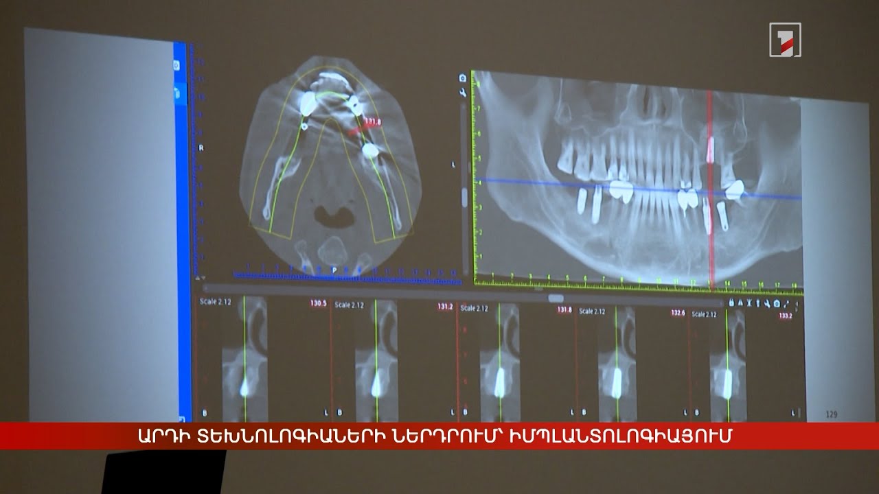 Արդի տեխնոլոգիաների ներդրում՝ իմպլանտոլոգիայում