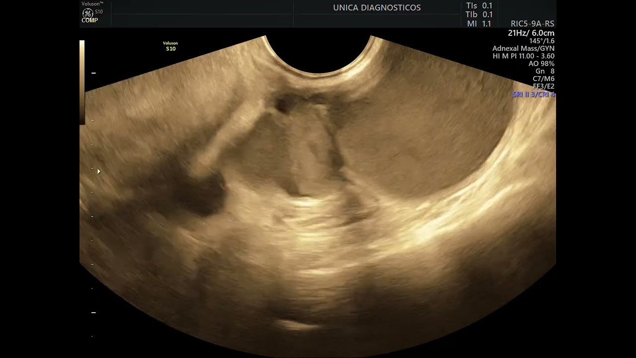 Vídeos de exames de endometriose Pt. 1