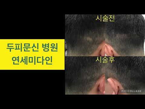 두피문신-모발 이식으로 인해 생긴 흉터 감쪽같은 해결방법은?