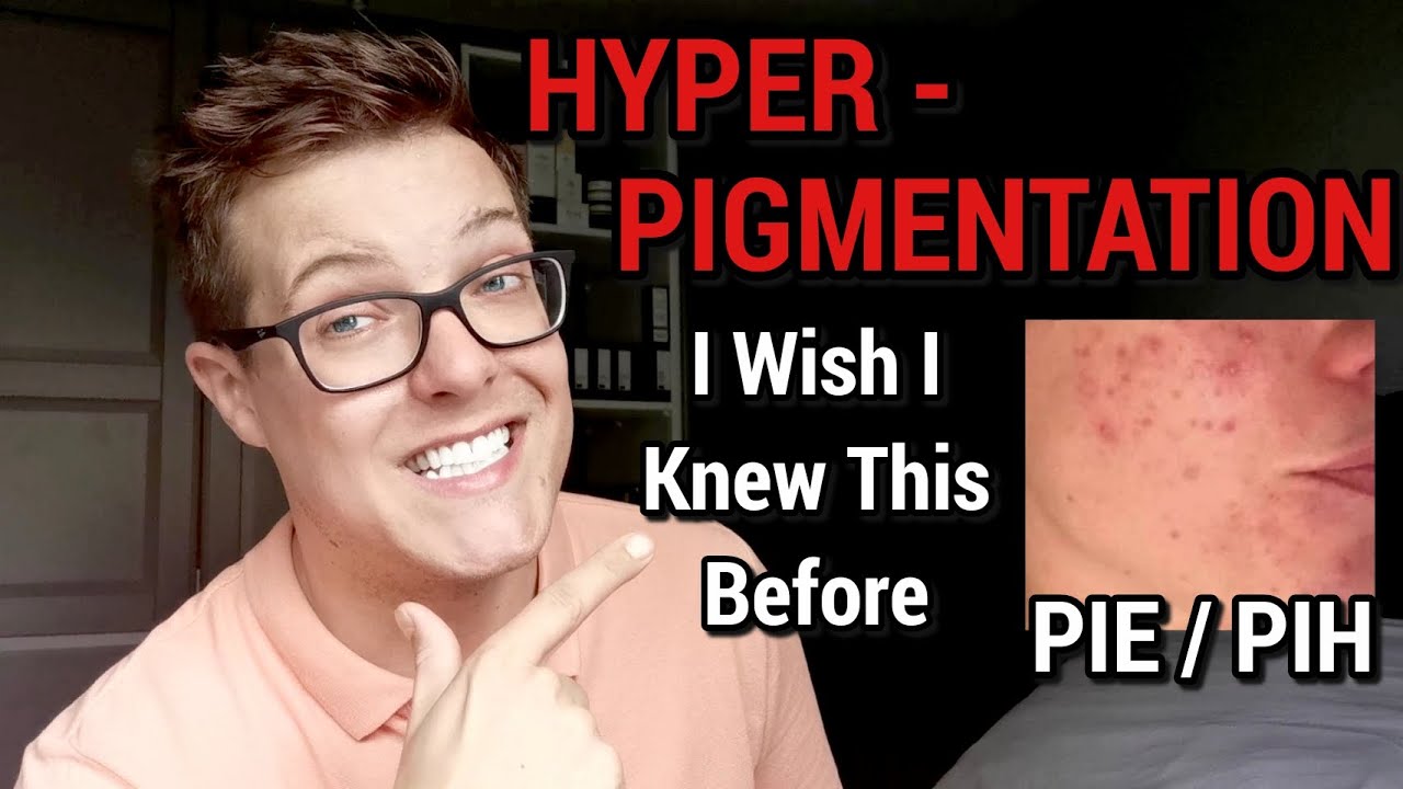 HYPERPIGMENTATION - 100% Effective Treatments (What Brands Wont Tell You)