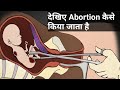 देखिए Abortion कैसे किया जाता है, Abortion and its type, Medical vs Surgical abort