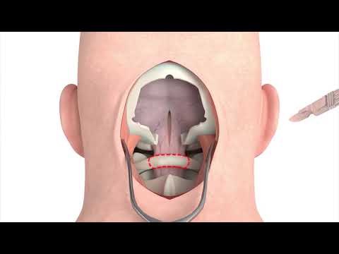 Craniectomy brain surgery - 3D animation Video