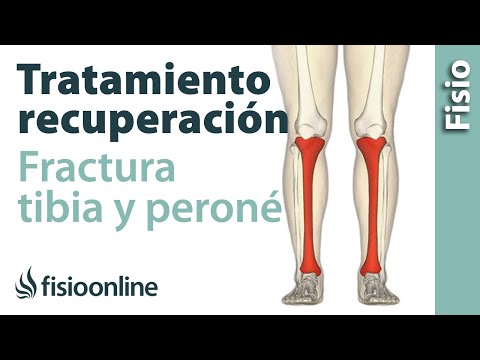 FRACTURA de TIBIA y PERONÉ.  Rehabilitación, ejercicios y tiempo de recuperación