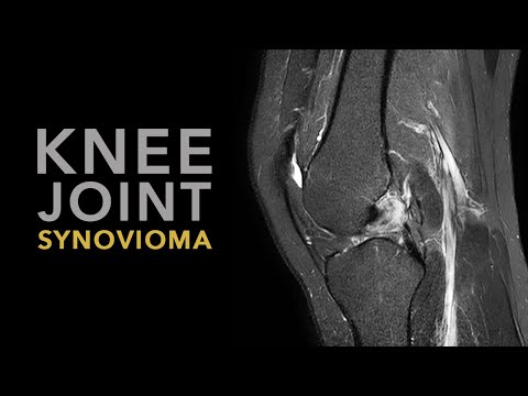 Osteochondrosis ár