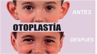 ¿QUÉ es la OTOPLASTÍA 👂 TIPOS de CIRUGÍA de OREJAS ⭐ Dr. ALBERTO CALVO QUIROZ