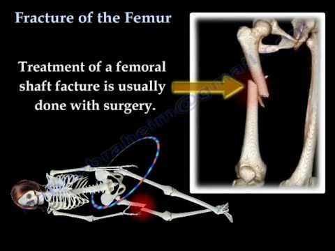 Fracture of the  Femur and  its  fixation - Everything You Need To Know - Dr. Nabil Ebraheim