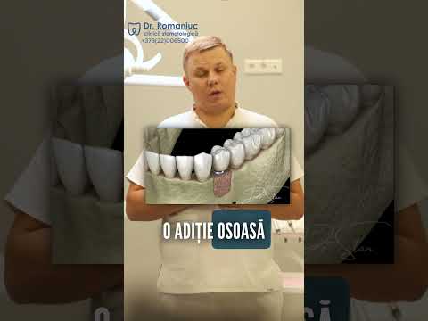 Factorii care influențează prețul unei danturi fixe