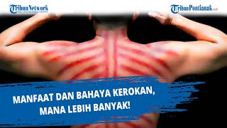 Download lagu Manfaat dan Bahaya Kerokan, Mana Lebih Banyak! mp3 Download lagu Manfaat dan Bahaya Kerokan, Mana Lebih Banyak! mp3