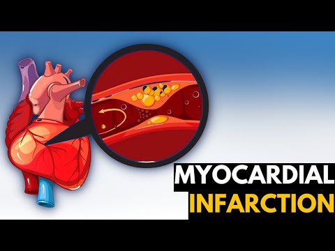 Myocardial Infarction, Causes, Signs and Symptoms, Diagnosis and Treatment.