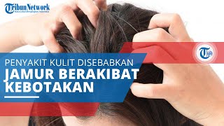 Tinea Capitis, Disebabkan Jamur Dermatofit yang Akibatkan Kulit Kepala Bersisik dan Kebotakan