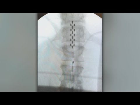 Click to Watch the HOPE IS FOUND: Paralyzed man regains movement in his legs after experimental electric treatment video