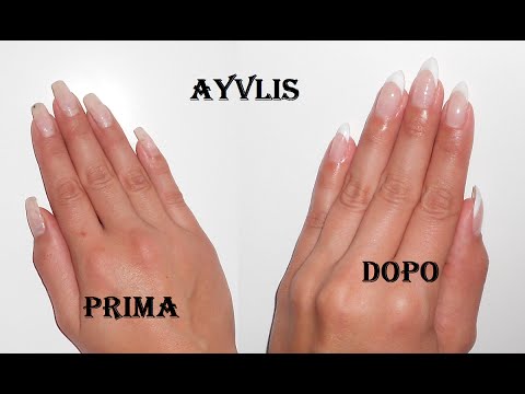 Neurodermatitis senza remissione Cura di psoriasi da medium