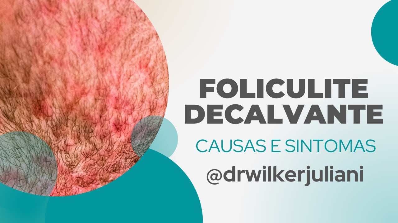Foliculite decalvante - CAUSAS E SINTOMAS
