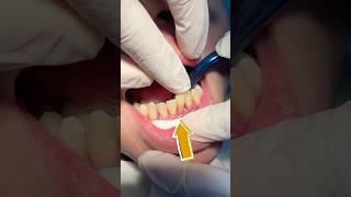 Download lagu Splinting Gigi adalah perawatan untuk gigi goyang #doktergigijakartapusat #doktergigijakartatimur mp3 Download lagu Splinting Gigi adalah perawatan untuk gigi goyang #doktergigijakartapusat #doktergigijakartatimur mp3