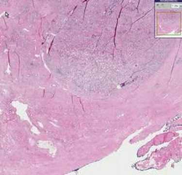 Aloe Prostata Fibrose Prostata-Hyperplasie Zyste