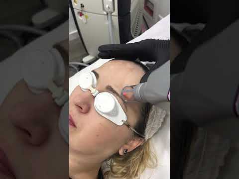 Come candeggiare una faccia da unustione solare Come distinguere un melanoma da un posto di pigmentary