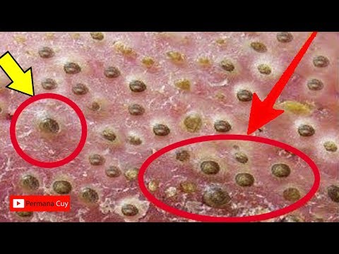 download lagu mp3 mp4 Cara Menghilangkan Jerawat Sampai Keakar Akarnya, download lagu Cara Menghilangkan Jerawat Sampai Keakar Akarnya gratis, unduh video klip Cara Menghilangkan Jerawat Sampai Keakar Akarnya