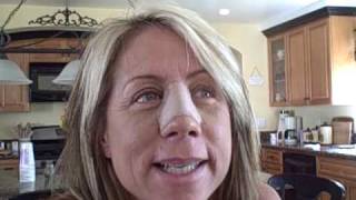 Dr. Nassif Did My New Nose: Day 9