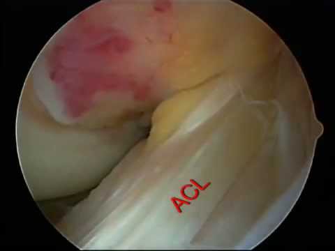 Artroscopia de rodilla