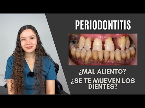Periodontitis | Odontologia Con Cri