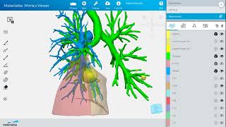 Materialise Mimics Planner for Thoracic Surgery