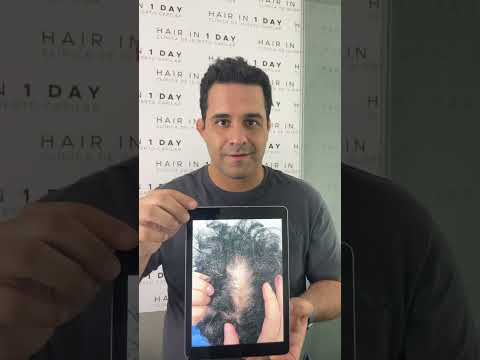 Rediscovering Confidence Through Hair Restoration in Guadalajara, Mexico: A Patient’s Journey at Hair in 1 Day