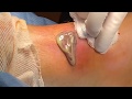 Draining pus from an abscess on an infected ankle
