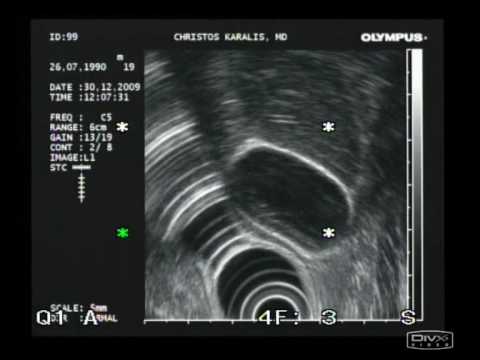 Gallbladder Polyps In Endoscopic Ultrasound 