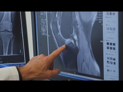 Künstliches Gelenk Leben In der linken Seite der Taille quälende Schmerzen