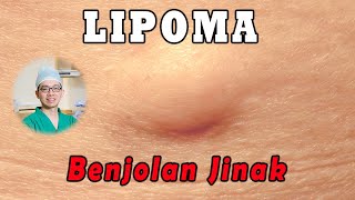 Download lagu LIPOMA (Tumor Jinak) - Benjolan Lunak mp3