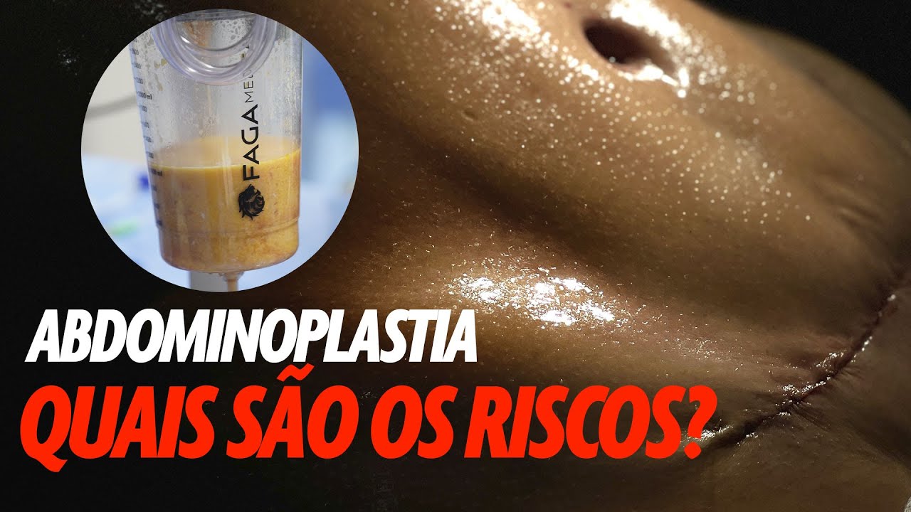 ABDOMINOPLASTIA QUAIS SÃO OS RISCOS? CIRUGIA PLASTICA