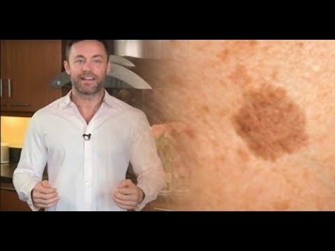 Отчего на локтях темные пятна и сухая кожа на Настя веснушка инстаграм