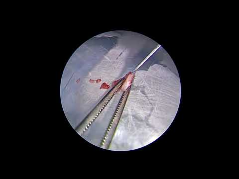 Endoscopic Butterfly Tympanoplasty for Eardrum Perforation