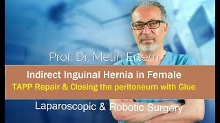 Miniaturka - TAPP Repair. Closing Peritoneum with Glue. Metin Ertem MD.FACS.