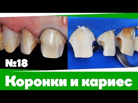 Коронки и кариес | Дентал Кейсы от BG #18