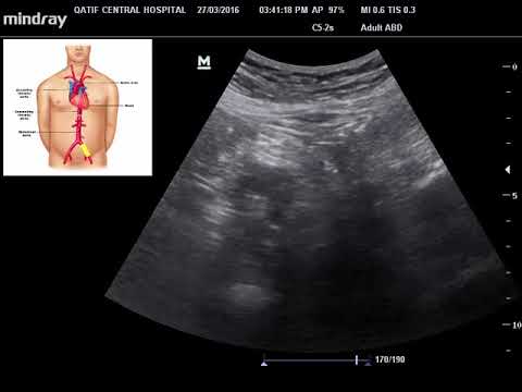 iliac artery aneurysm